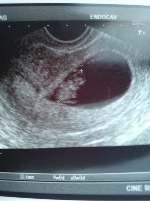 Buscadoras después de uno o varios abortos  - 1