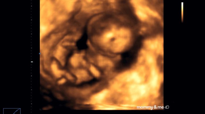 Buscadoras después de uno o varios abortos  - 1