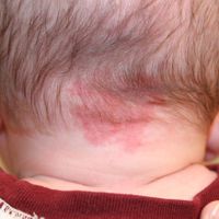 angioma bebe nuca