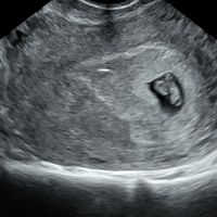 Ayuda con método ramzi: niño o niña? - 1