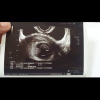 Ayuda con método ramzi: niño o niña? - 1