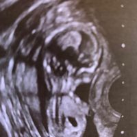 Ayuda con método ramzi: niño o niña? - 1