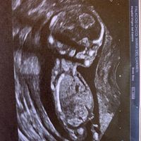 Ayuda con método ramzi: niño o niña? - 3