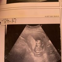 Ayuda con método ramzi: niño o niña? - 4