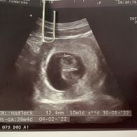 Ayuda con método ramzi: niño o niña? - 1