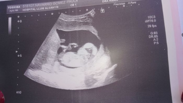 Buscadoras después de uno o varios abortos ii - 1
