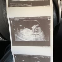 Tubérculo genital: niña - 1