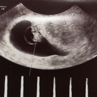 Ayuda con método ramzi: niño o niña? - 1
