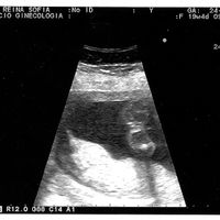 19 semanas "el chochete de mi niña"