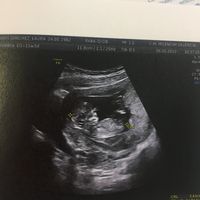 Eco de 13 semanas: niña o niño? - 1