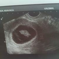 Ayuda con método ramzi: niño o niña? - 1
