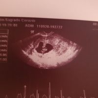 Ayuda con método ramzi: niño o niña? - 1