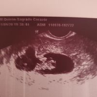 Ayuda con método ramzi: niño o niña? - 2