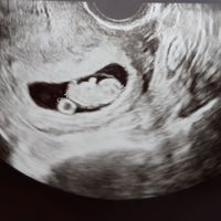 Ayuda con método ramzi: niño o niña? - 1