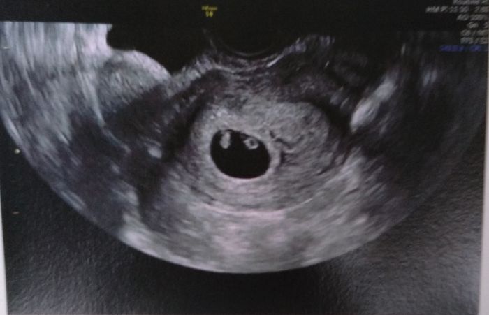 Ayuda con método ramzi: niño o niña? 8