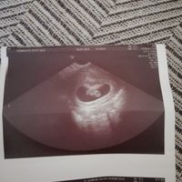 Ayuda con método ramzi: niño o niña? - 1