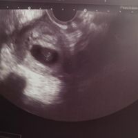 Ayuda con método ramzi: niño o niña? - 1