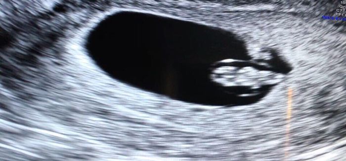 Ayuda con método ramzi: niño o niña? - 1