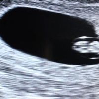Ayuda con método ramzi: niño o niña? - 1
