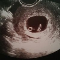 Ayuda con método ramzi: niño o niña? - 1