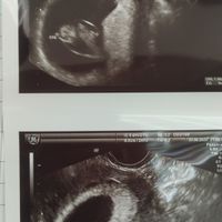 Ayuda con método ramzi: niño o niña? - 1