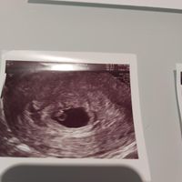 Ayuda con método ramzi: niño o niña? - 1