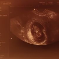 Ayuda con método ramzi: niño o niña? - 1