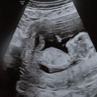 Ayuda con método ramzi: niño o niña? - 1