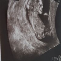 Ayuda con método ramzi: niño o niña? - 1