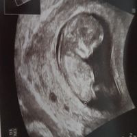 Ayuda con método ramzi: niño o niña? - 2