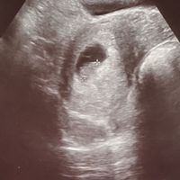 Ayuda con método ramzi: niño o niña? - 1