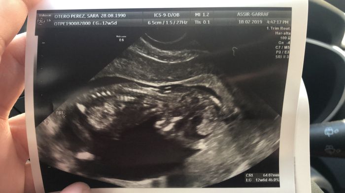 Tubérculo genital niño o niña??? 10