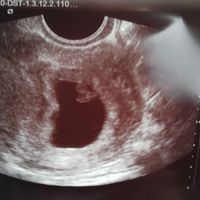 Ayuda con método ramzi: niño o niña? - 1
