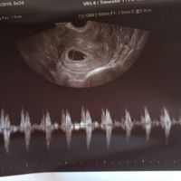 Ayuda con método ramzi: niño o niña? - 1