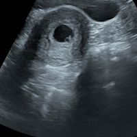 Ayuda con método ramzi: niño o niña? - 1