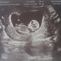Ayuda con método ramzi: niño o niña? - 1