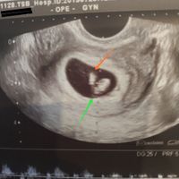 Ayuda con método ramzi: niño o niña? - 1
