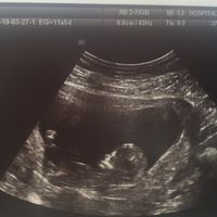 Ayuda con método ramzi: niño o niña? - 1