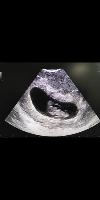 Ayuda con método ramzi: niño o niña? - 1