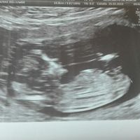 Ayuda con método ramzi: niño o niña? - 1