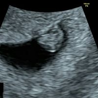 Ayuda con método ramzi: niño o niña? - 1