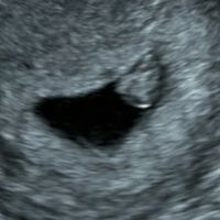 Ayuda con método ramzi: niño o niña? - 3