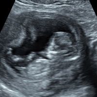 Ayuda con método ramzi: niño o niña? - 1
