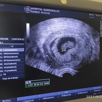 Ayuda con método ramzi: niño o niña? - 1