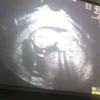 Ayuda con método ramzi: niño o niña? - 2