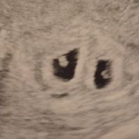 Ayuda con método ramzi: niño o niña? - 1