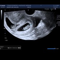 Ayuda con método ramzi: niño o niña? - 1