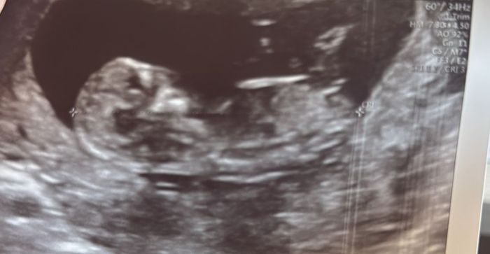 Alguien sabe identificar el sexo del bebe según el tubérculo? 4