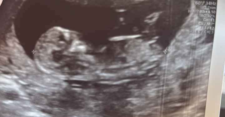 Alguien sabe identificar el sexo del bebe según el tubérculo? - 1