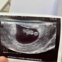 Ayuda con método ramzi: niño o niña? - 1